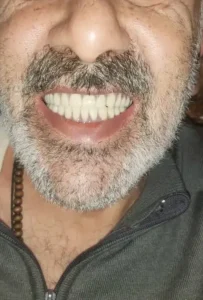 عکس دندان مصنوعی در دهان