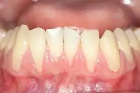 عوامل تحلیل لثه چیست؟(روش درمان تحلیل لثه)

