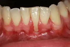 عوامل تحلیل لثه چیست؟(روش درمان تحلیل لثه)